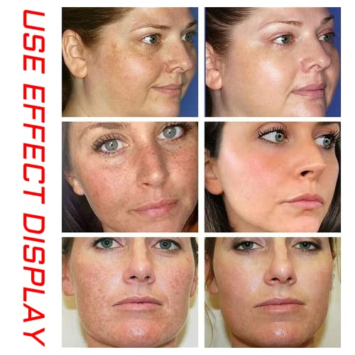 Acne Cleansing Cream Blackhead Skin Care
