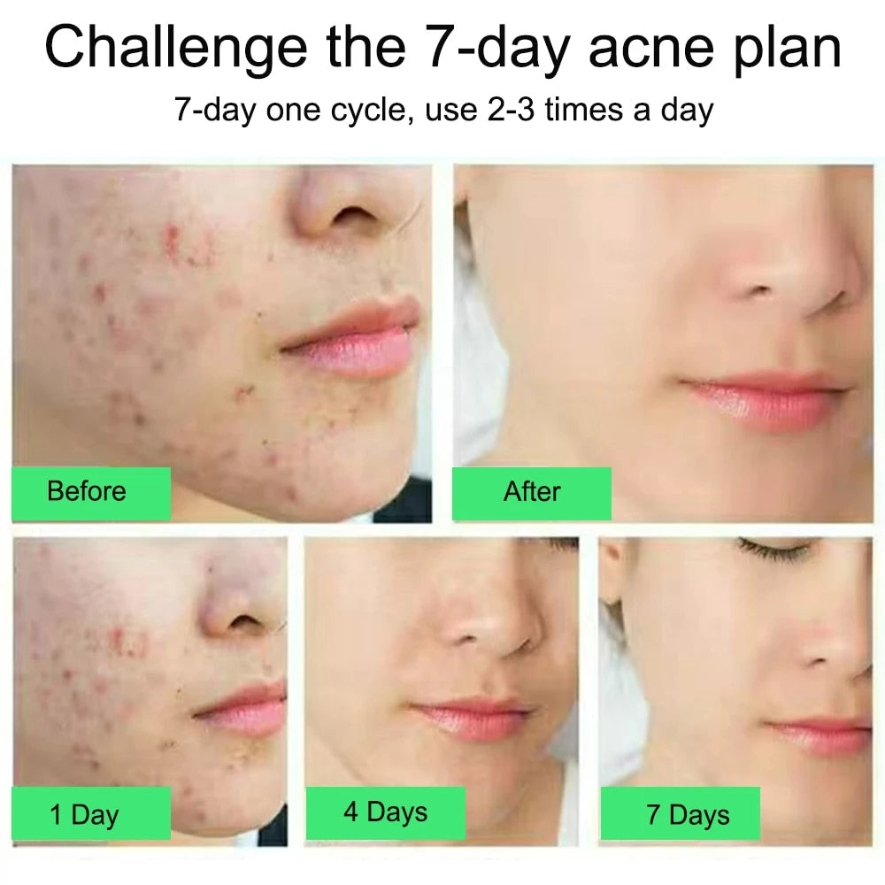Acne Cleansing Cream Blackhead Skin Care
