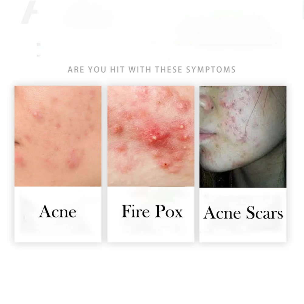 Acne Cleansing Cream Blackhead Skin Care