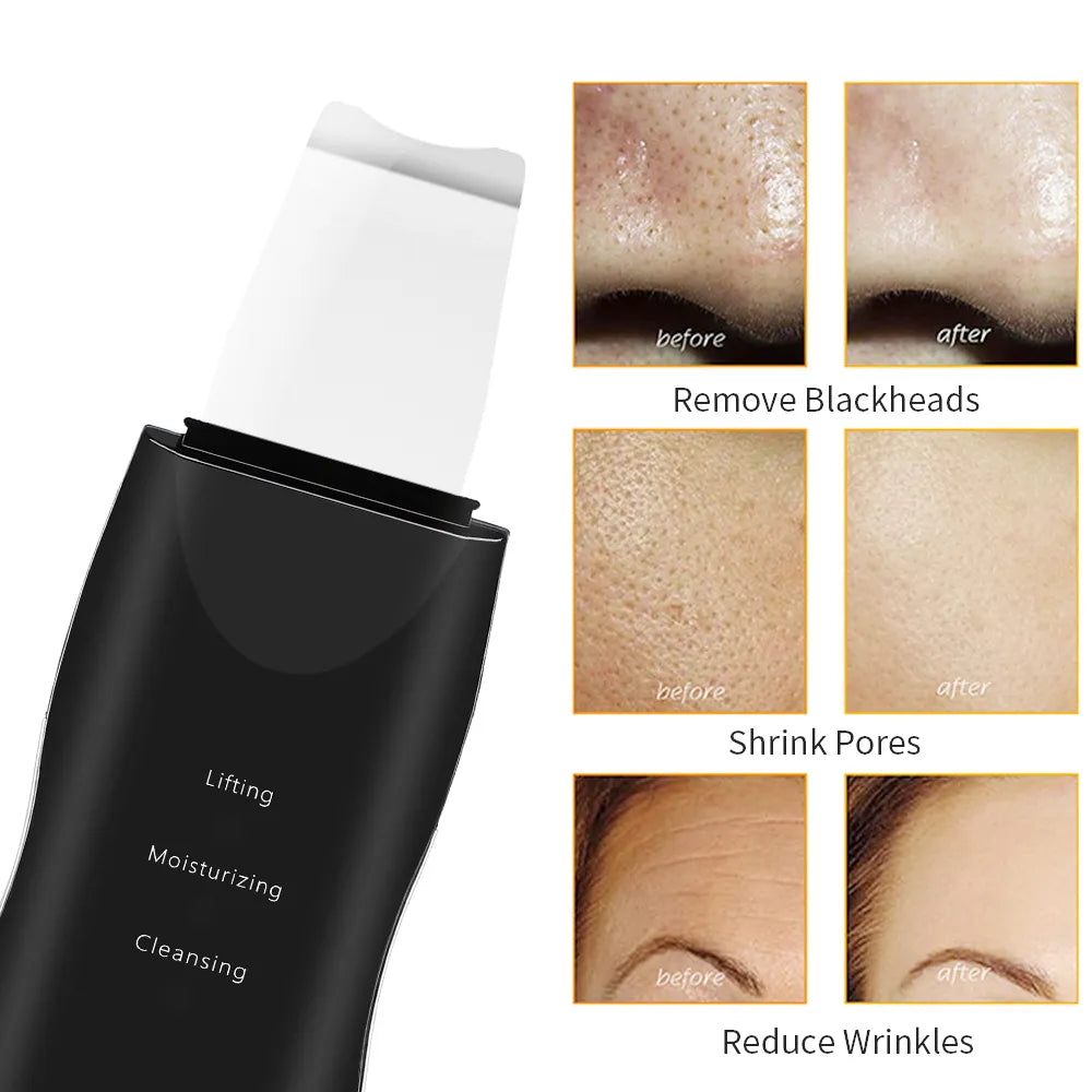 Ultrasonic Skin Scrubber - Gentle Face Shovel & Applicator Tool for Pore Cleansing, Blackhead Removal